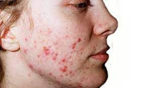 Jerawat (Acne Vulgaris)